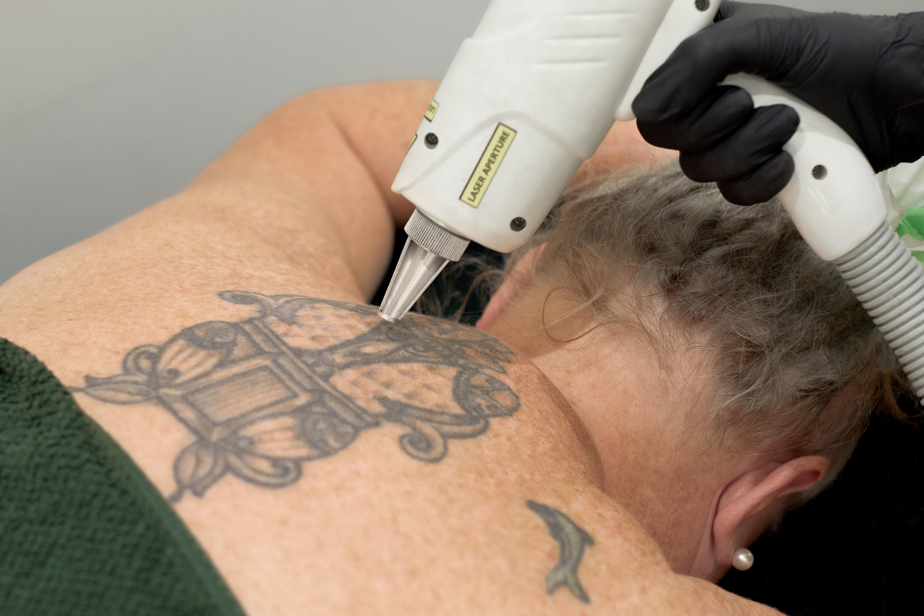 image of Tattoo Removal treatment