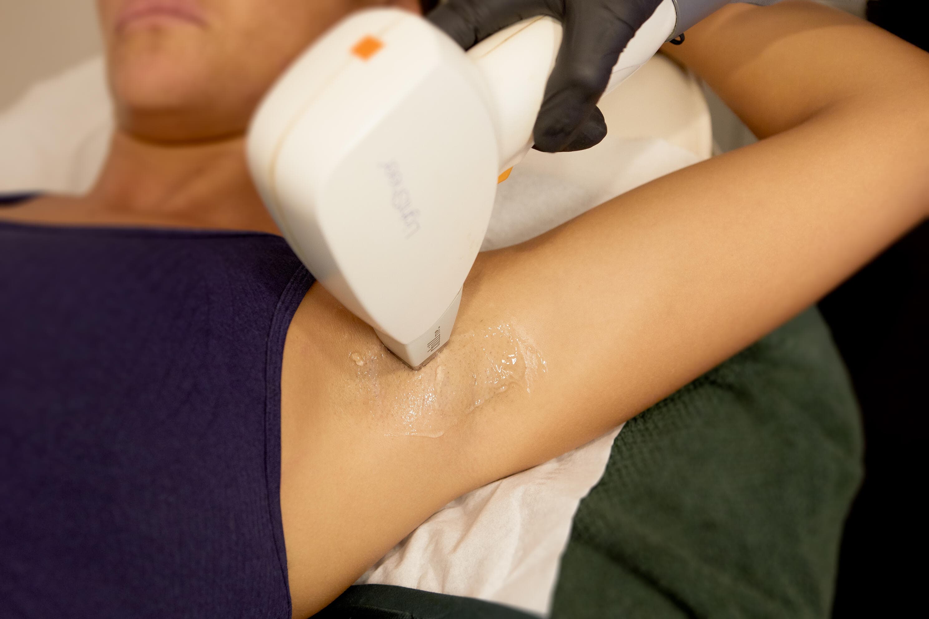 image of Cheek Hair Laser Hair Removal treatment