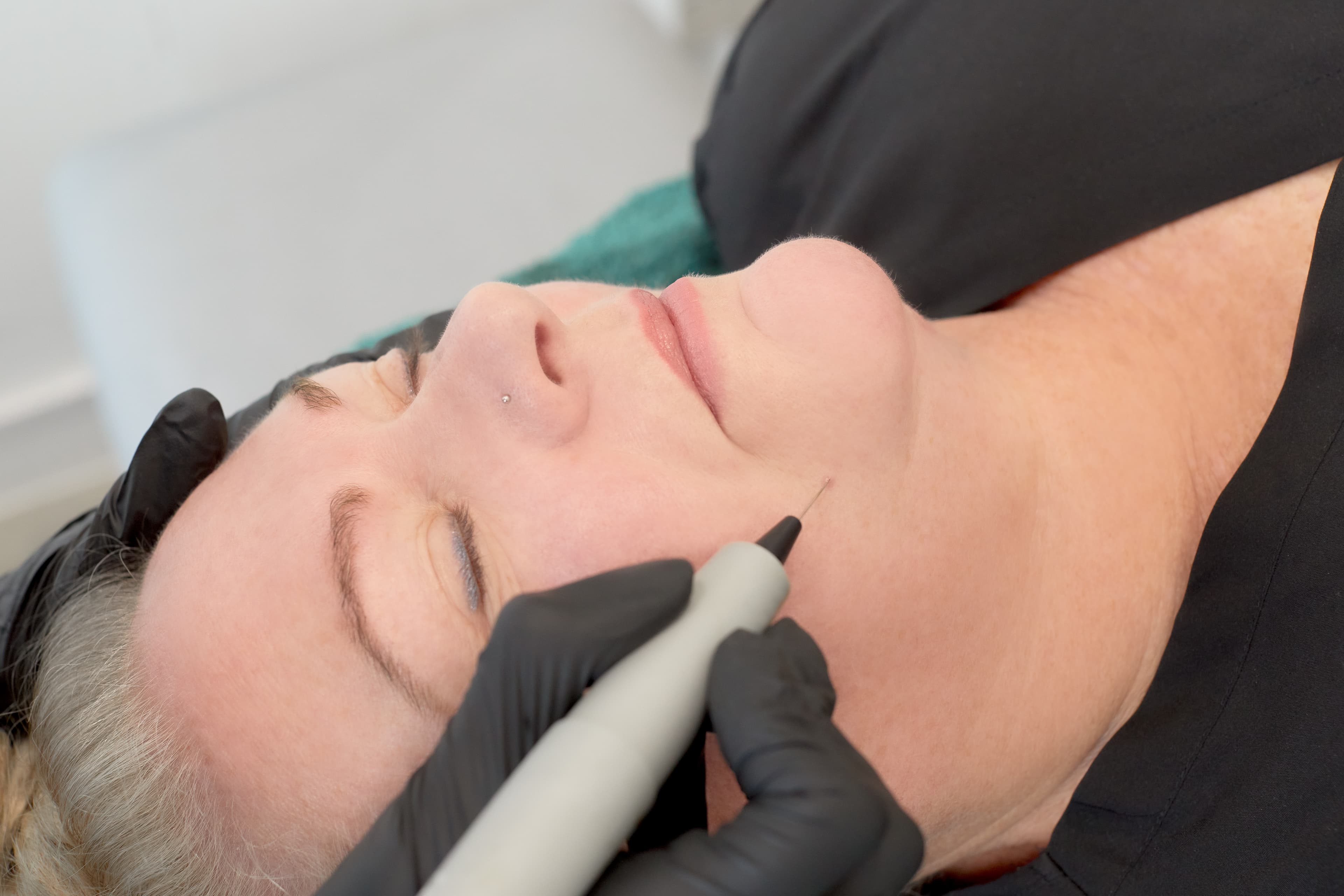 A client receiving a Plasma fibroblast treatment